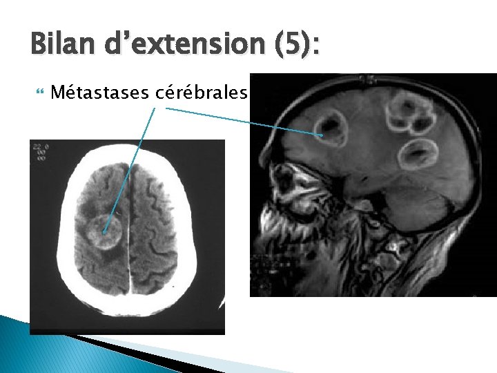 Bilan d’extension (5): Métastases cérébrales 
