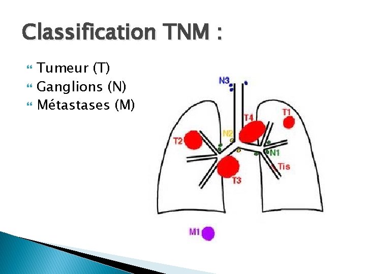 Classification TNM : Tumeur (T) Ganglions (N) Métastases (M) 