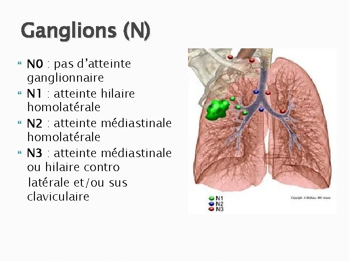 Ganglions (N) N 0 : pas d’atteinte ganglionnaire N 1 : atteinte hilaire homolatérale