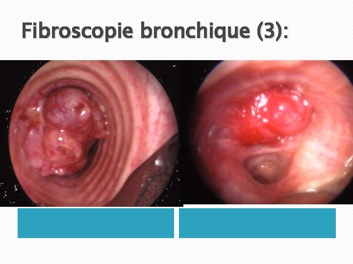 Fibroscopie bronchique (3): 