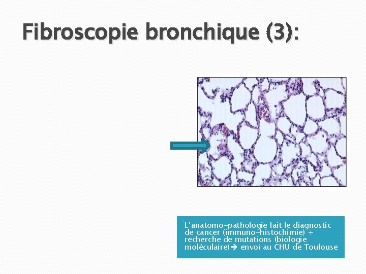 Fibroscopie bronchique (3): L’anatomo-pathologie fait le diagnostic de cancer (immuno-histochimie) + recherche de mutations