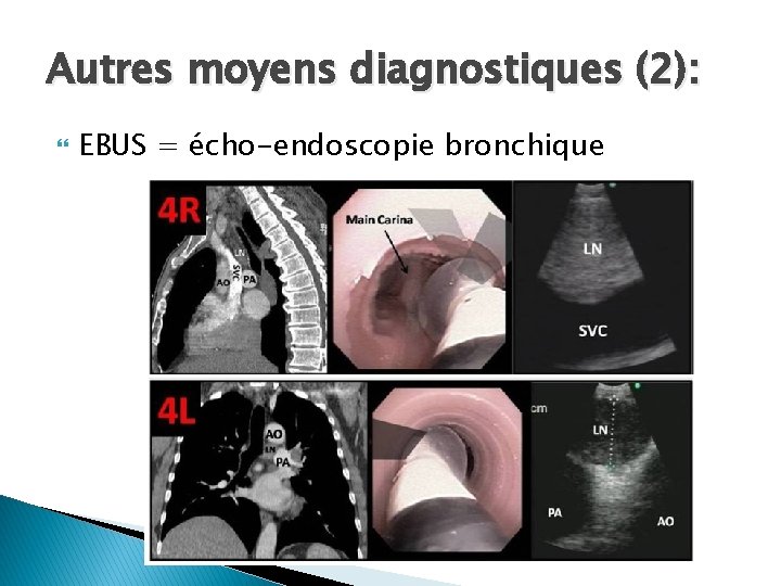 Autres moyens diagnostiques (2): EBUS = écho-endoscopie bronchique 