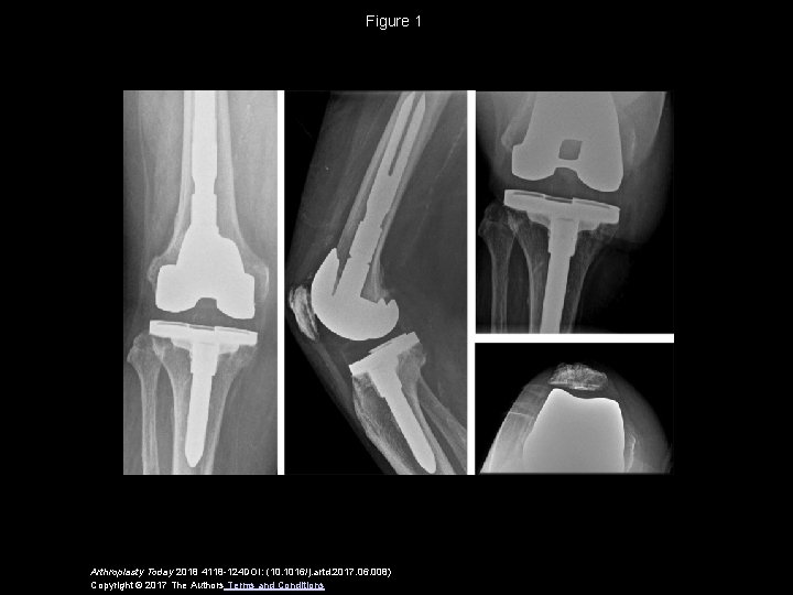 Figure 1 Arthroplasty Today 2018 4118 -124 DOI: (10. 1016/j. artd. 2017. 06. 008)