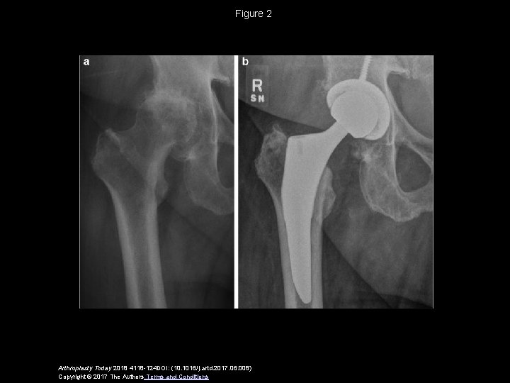 Figure 2 Arthroplasty Today 2018 4118 -124 DOI: (10. 1016/j. artd. 2017. 06. 008)