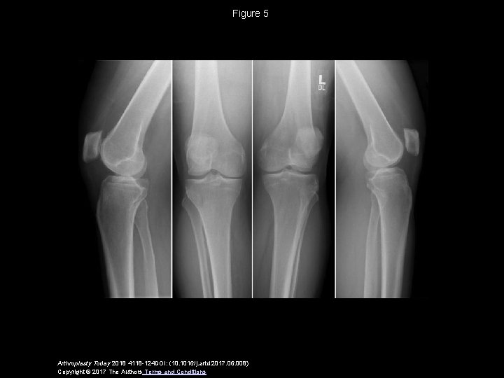 Figure 5 Arthroplasty Today 2018 4118 -124 DOI: (10. 1016/j. artd. 2017. 06. 008)