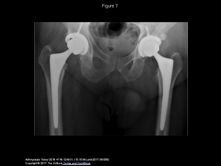 Figure 7 Arthroplasty Today 2018 4118 -124 DOI: (10. 1016/j. artd. 2017. 06. 008)