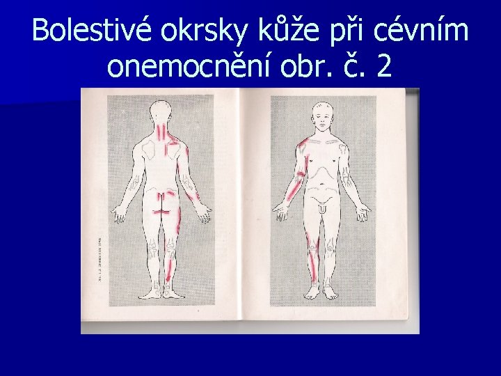 Bolestivé okrsky kůže při cévním onemocnění obr. č. 2 