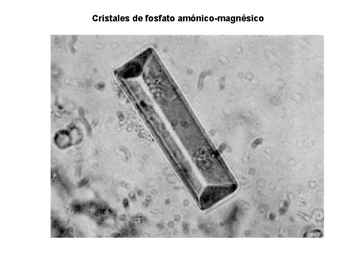 Cristales de fosfato amónico-magnésico 