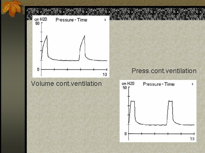Press. cont. ventilation Volume cont. ventilation 