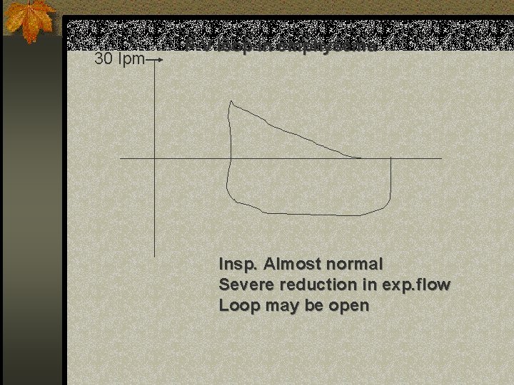 30 lpm F-V loop in emphysema Insp. Almost normal Severe reduction in exp. flow