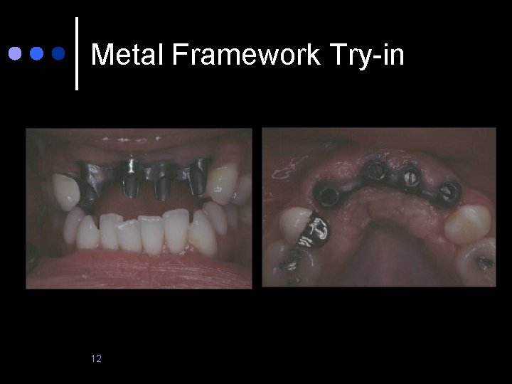 Metal Framework Try-in 12 