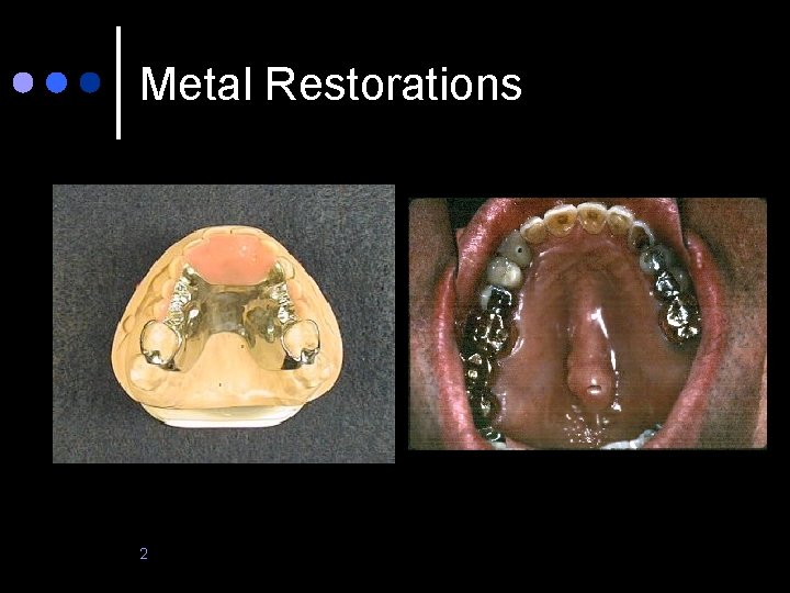 Metal Restorations 2 