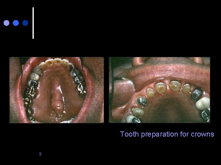Tooth preparation for crowns 3 