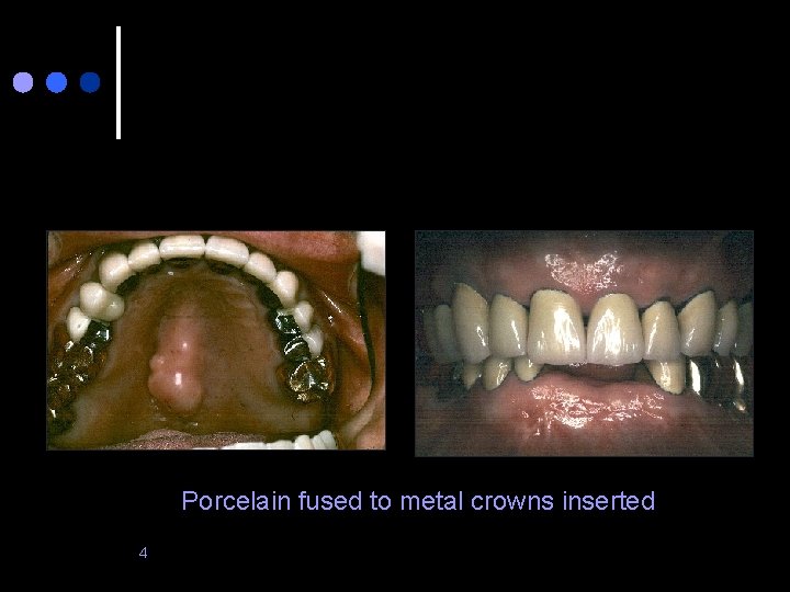 Porcelain fused to metal crowns inserted 4 