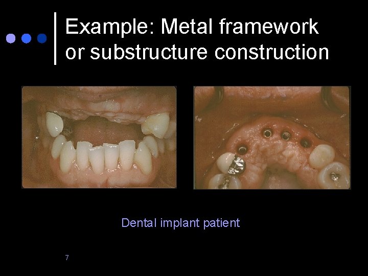 Example: Metal framework or substructure construction Dental implant patient 7 