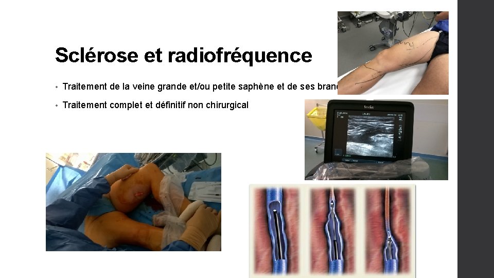 Sclérose et radiofréquence • Traitement de la veine grande et/ou petite saphène et de