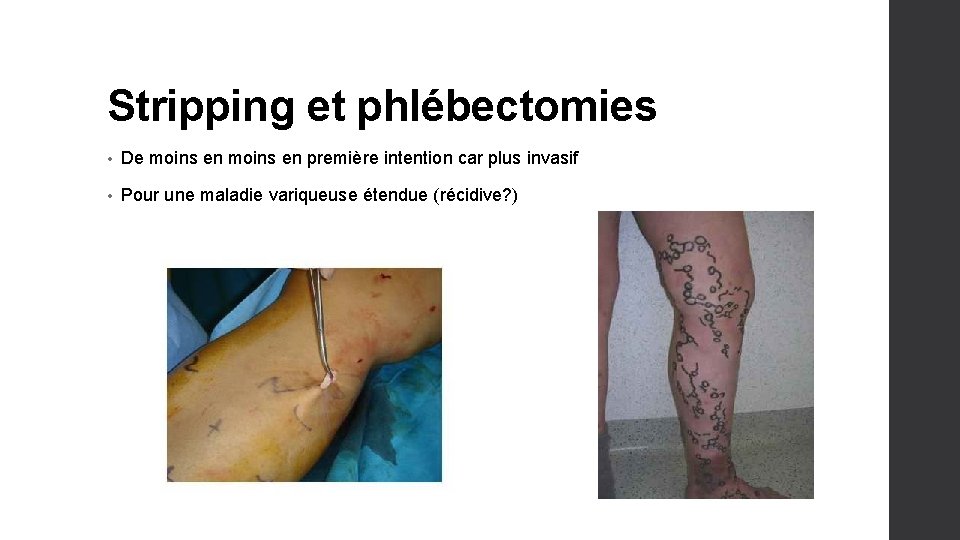 Stripping et phlébectomies • De moins en première intention car plus invasif • Pour