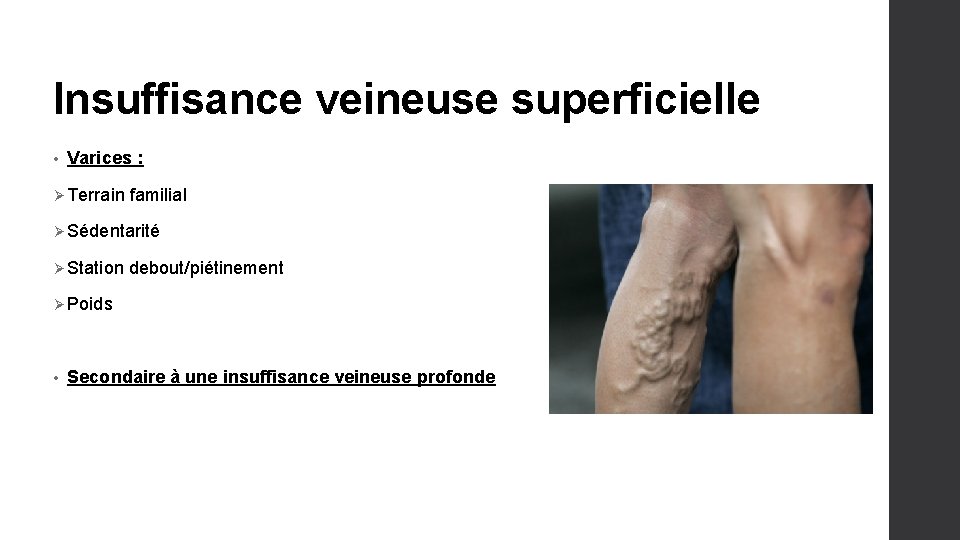 Insuffisance veineuse superficielle • Varices : Ø Terrain familial Ø Sédentarité Ø Station debout/piétinement