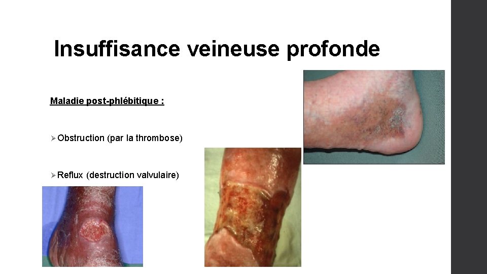 Insuffisance veineuse profonde Maladie post-phlébitique : Ø Obstruction (par la thrombose) Ø Reflux (destruction