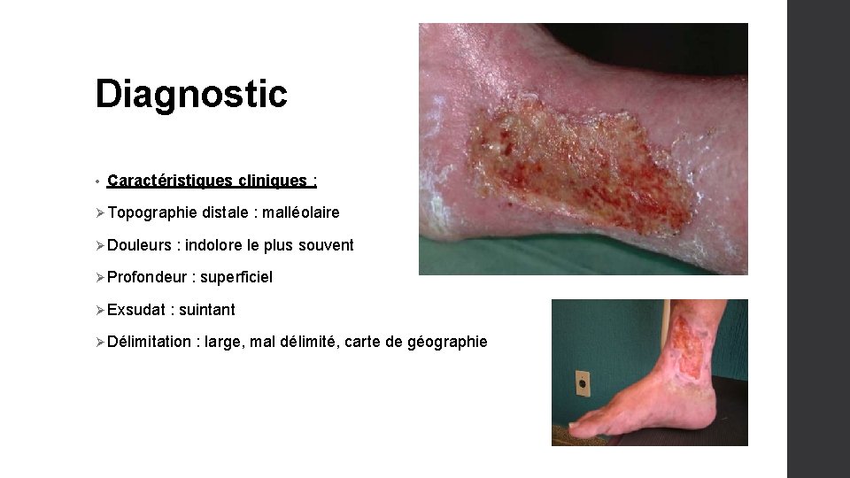 Diagnostic • Caractéristiques cliniques : Ø Topographie distale : malléolaire Ø Douleurs : indolore
