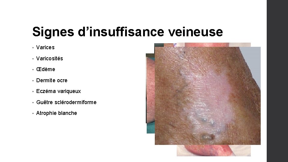 Signes d’insuffisance veineuse • Varices • Varicosités • Œdème • Dermite ocre • Eczéma