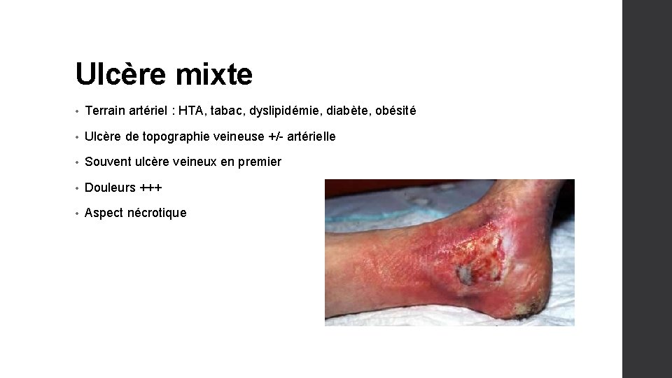 Ulcère mixte • Terrain artériel : HTA, tabac, dyslipidémie, diabète, obésité • Ulcère de