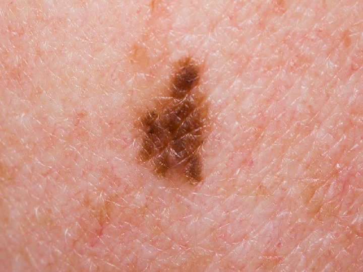 � Melanoma � Non- melanoma 