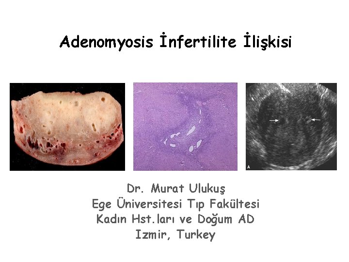 Adenomyosis İnfertilite İlişkisi Dr. Murat Ulukuş Ege Üniversitesi Tıp Fakültesi Kadın Hst. ları ve