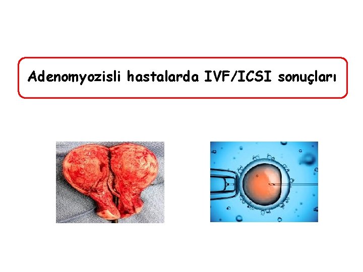 Adenomyozisli hastalarda IVF/ICSI sonuçları 