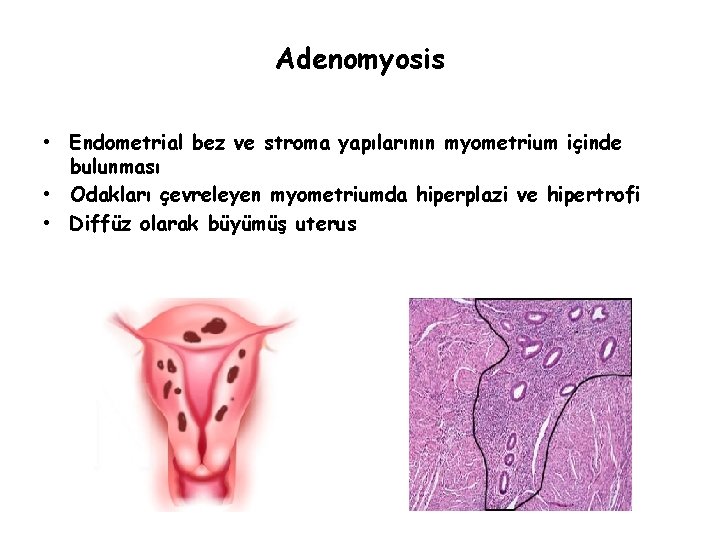 Adenomyosis • Endometrial bez ve stroma yapılarının myometrium içinde bulunması • Odakları çevreleyen myometriumda