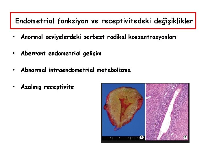 Endometrial fonksiyon ve receptivitedeki değişiklikler • Anormal seviyelerdeki serbest radikal konsantrasyonları • Aberrant endometrial