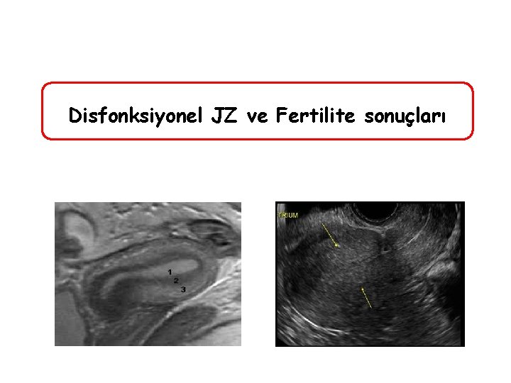 Disfonksiyonel JZ ve Fertilite sonuçları 