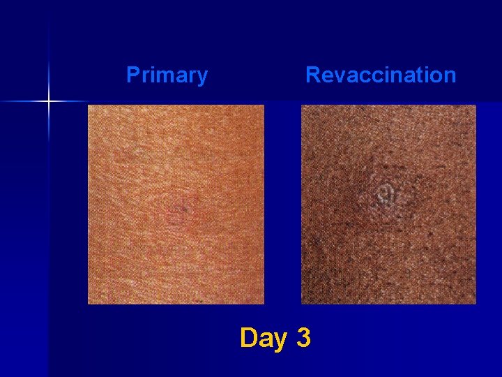 Primary Revaccination Day 3 