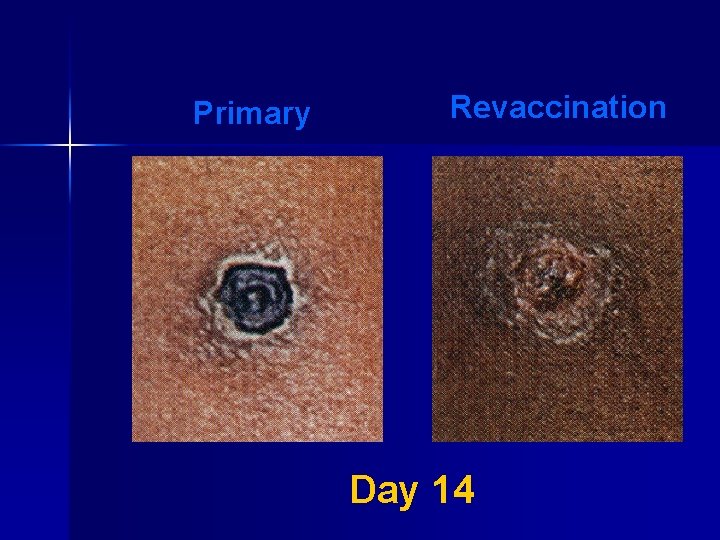 Primary Revaccination Day 14 