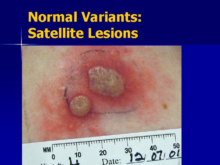 Normal Variants: Satellite Lesions 
