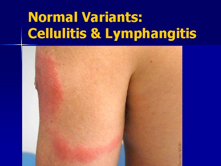 Normal Variants: Cellulitis & Lymphangitis 