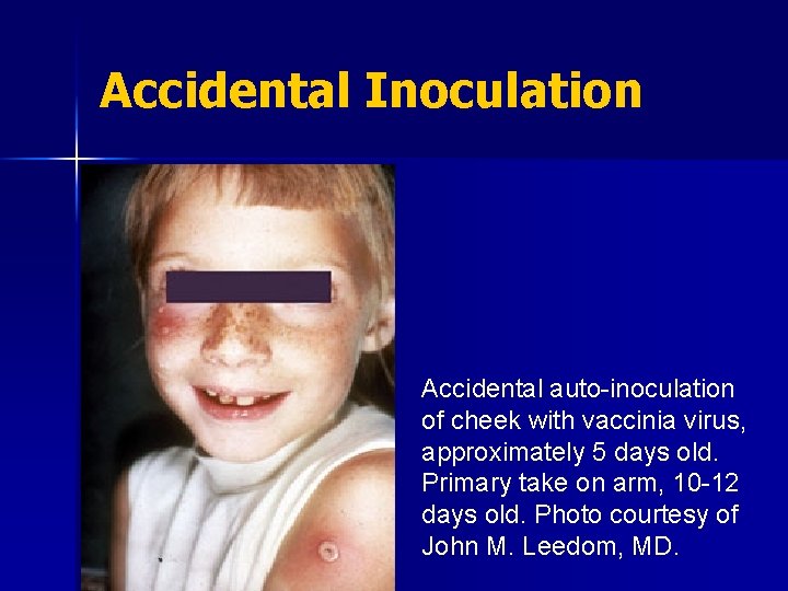 Accidental Inoculation Accidental auto-inoculation of cheek with vaccinia virus, approximately 5 days old. Primary