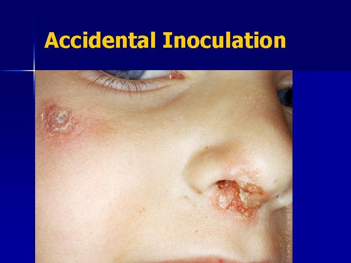 Accidental Inoculation 