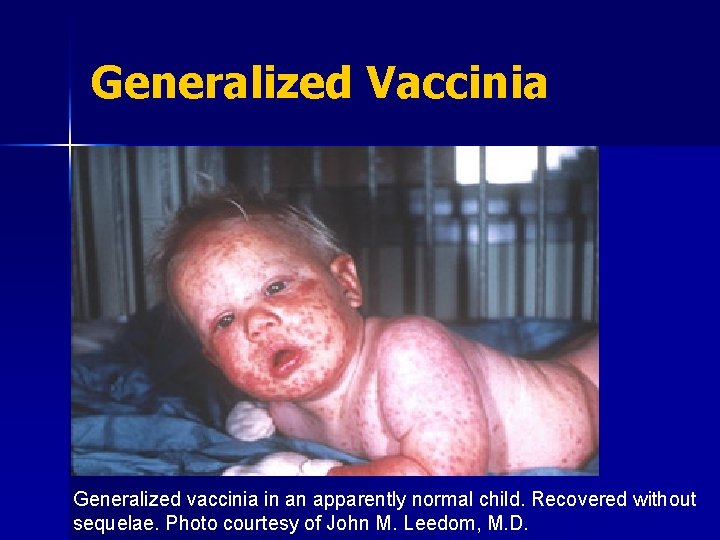 Generalized Vaccinia Generalized vaccinia in an apparently normal child. Recovered without sequelae. Photo courtesy