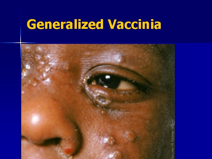Generalized Vaccinia 