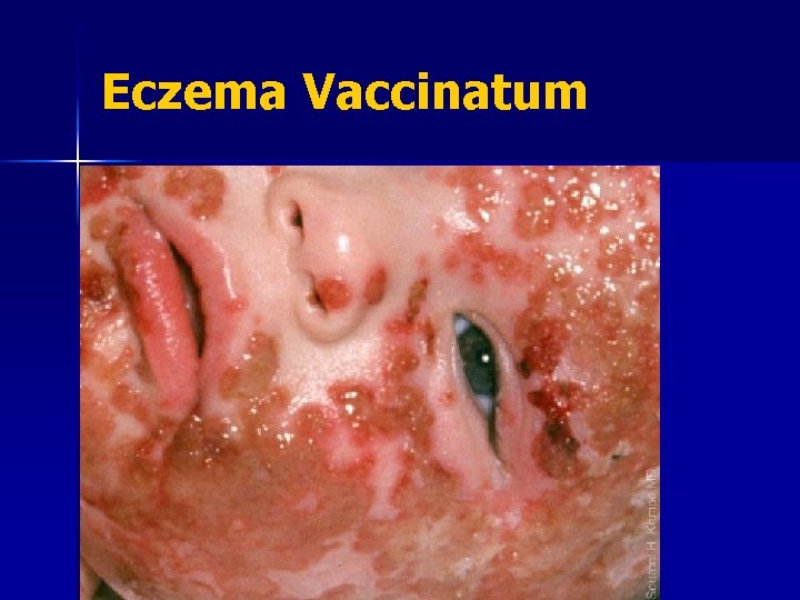 Eczema Vaccinatum 