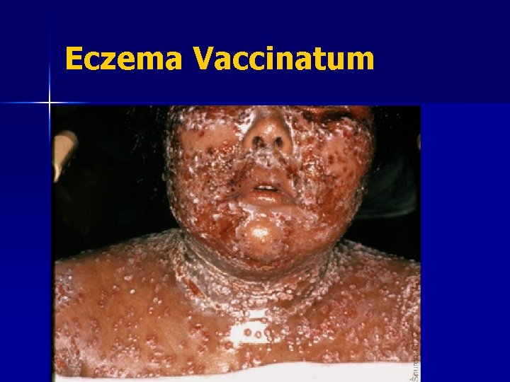 Eczema Vaccinatum 