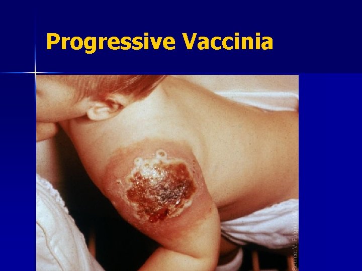 Progressive Vaccinia 