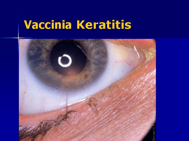 Vaccinia Keratitis 