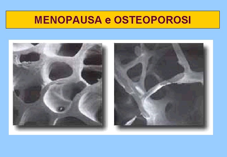 MENOPAUSA e OSTEOPOROSI 