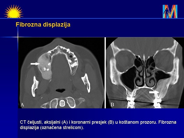 Fibrozna displazija CT čeljusti, aksijalni (A) i koronarni presjek (B) u koštanom prozoru. Fibrozna