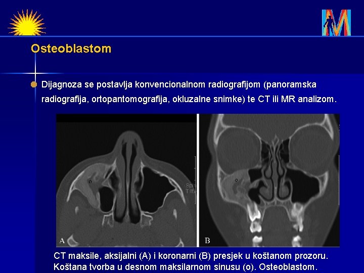Osteoblastom Dijagnoza se postavlja konvencionalnom radiografijom (panoramska radiografija, ortopantomografija, okluzalne snimke) te CT ili