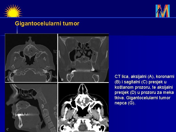 Gigantocelularni tumor CT lica, aksijalni (A), koronarni (B) i sagitalni (C) presjek u koštanom