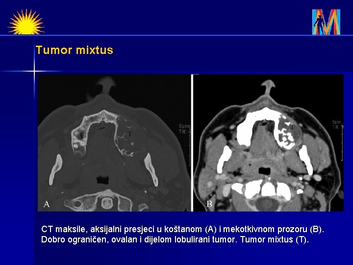 Tumor mixtus CT maksile, aksijalni presjeci u koštanom (A) i mekotkivnom prozoru (B). Dobro