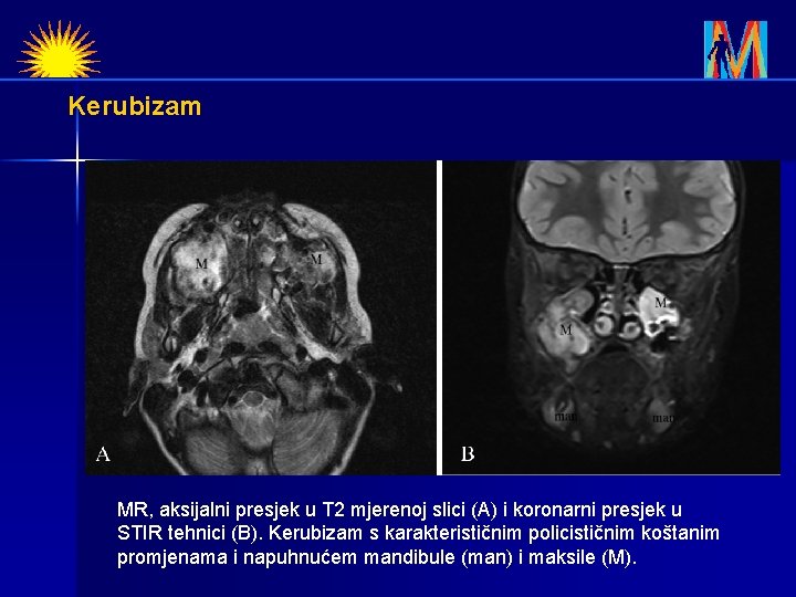 Kerubizam MR, aksijalni presjek u T 2 mjerenoj slici (A) i koronarni presjek u